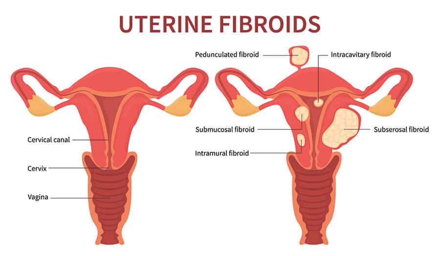 uterine fibroids compared to a healthy uterus