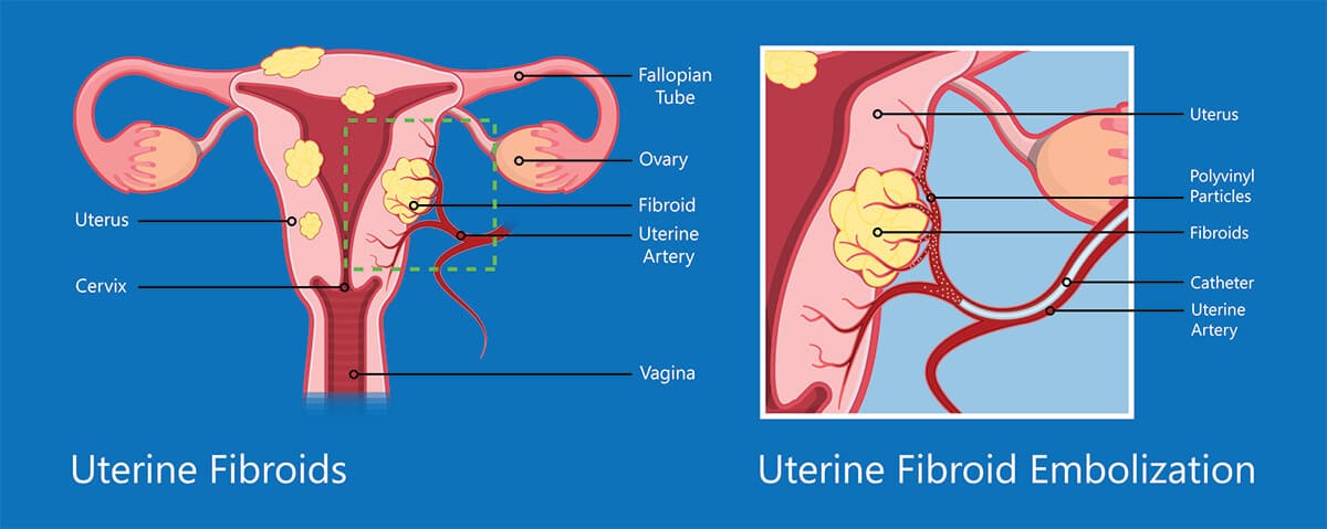 Chart showing the minimally invasive uterine fibroid embolization procedure