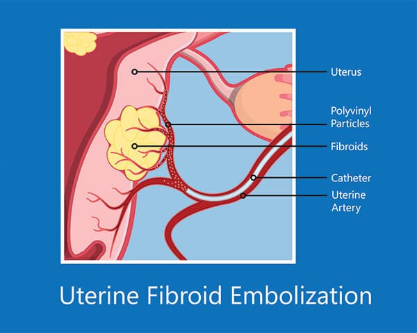 Options and outcomes for uterine preservation at the time of