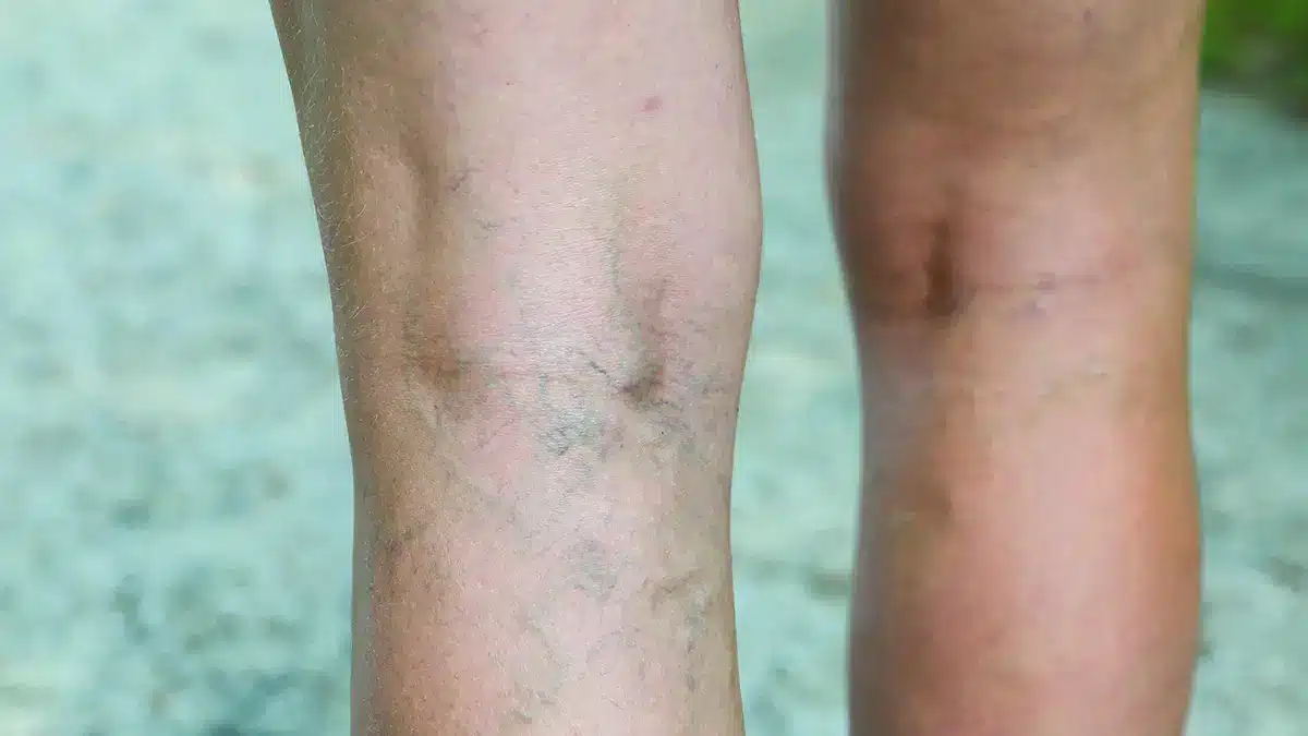 varicose veins on an elderly woman's leg