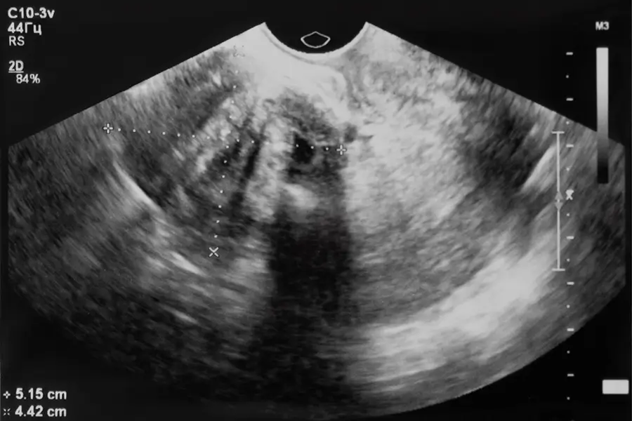 X-Ray of uterine fibroid to determine size