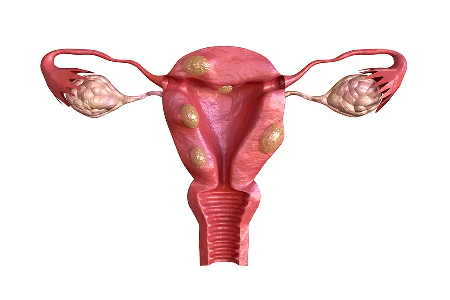 Fibromas uterinos en el útero